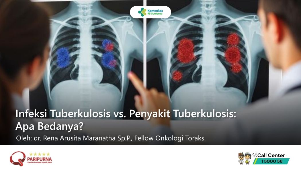 Infeksi Tuberkulosis vs. Penyakit Tuberkulosis: Apa Bedanya?