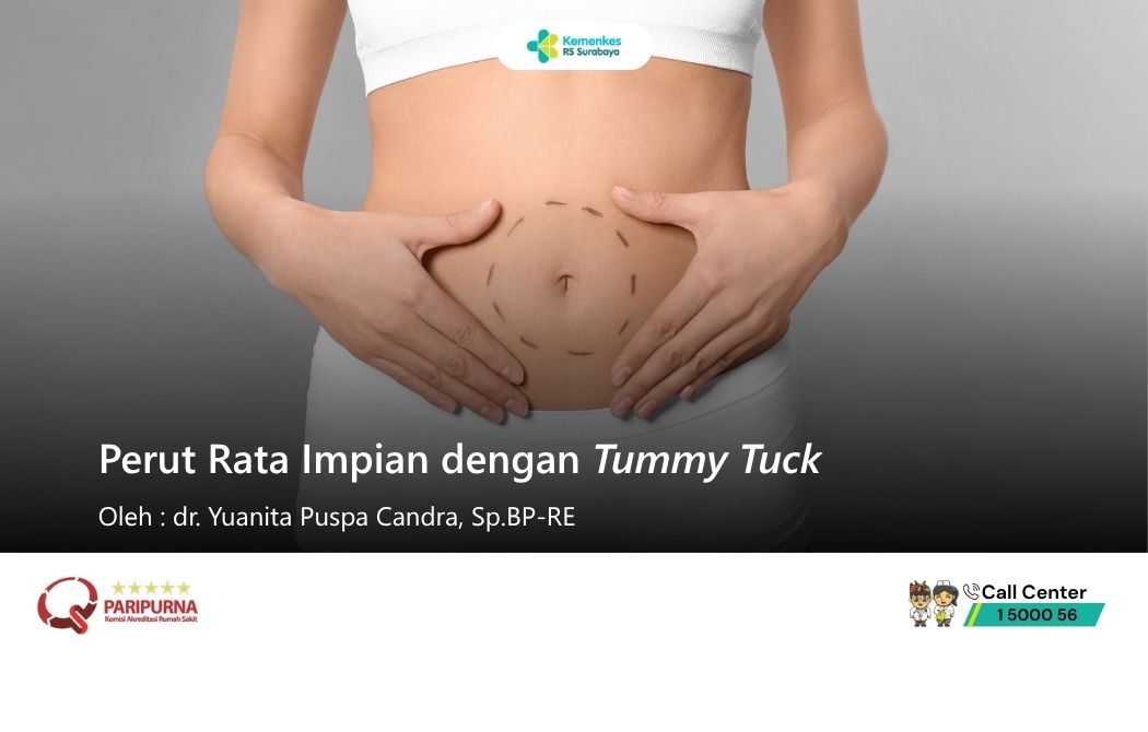 Perut Rata Impian dengan Tummy Tuck