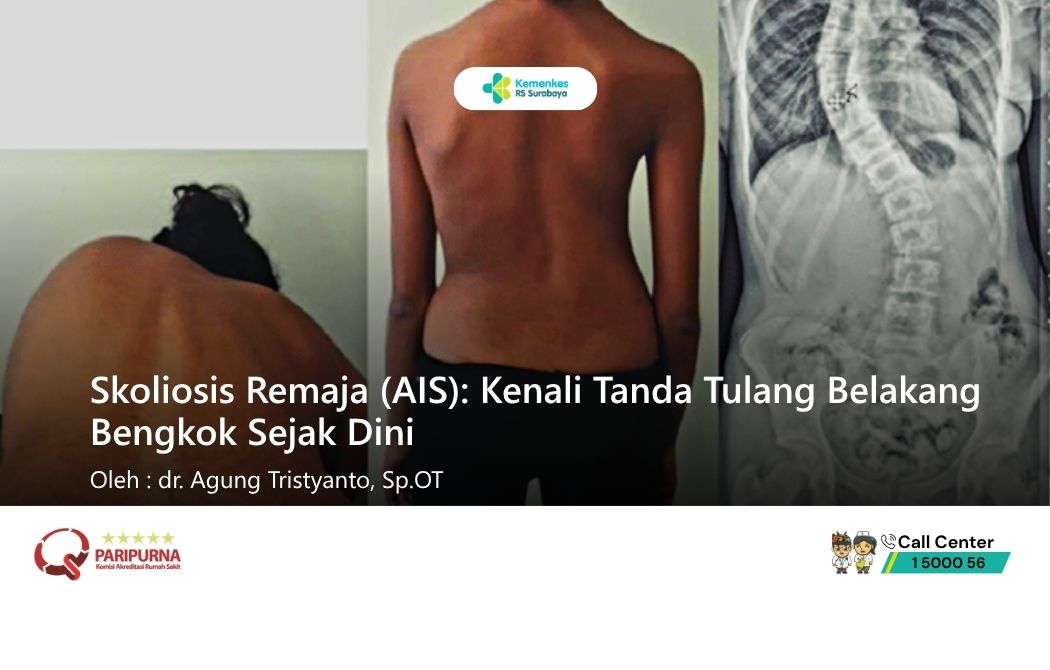 Skoliosis Remaja (AIS): Kenali Tanda Tulang Belakang Bengkok Sejak Dini