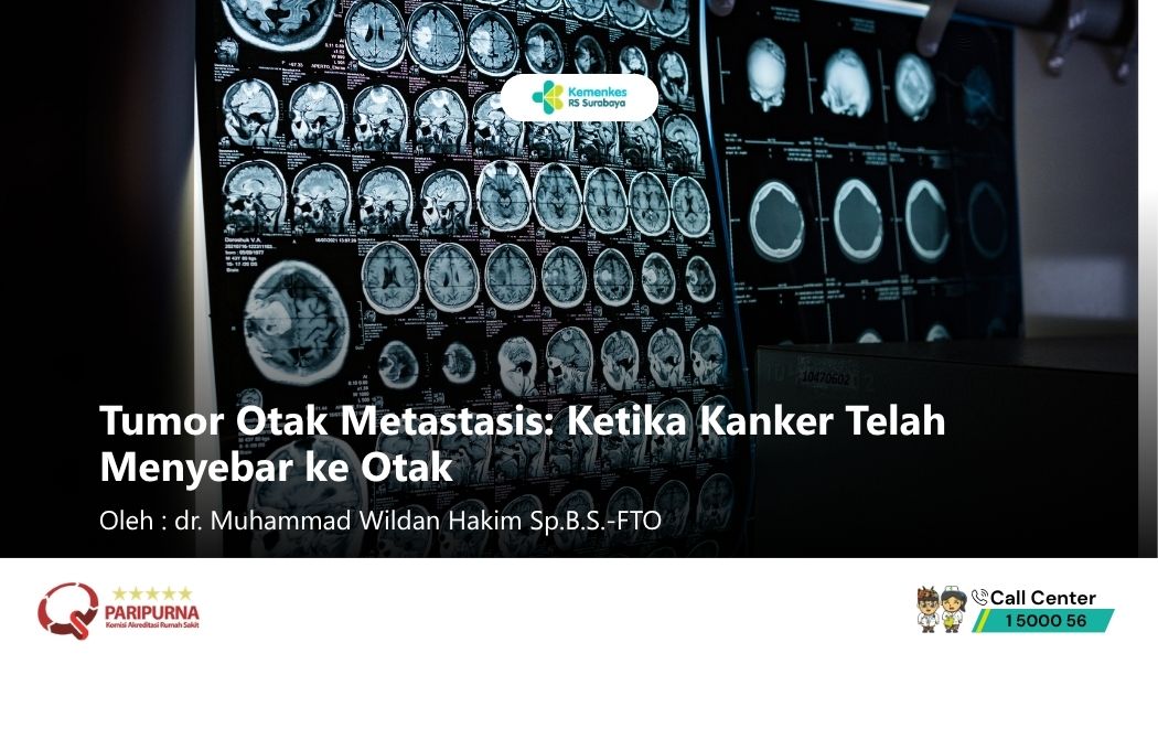 Tumor Otak Metastasis: Ketika Kanker Telah Menyebar ke Otak