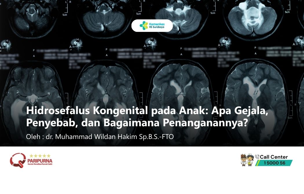 Hidrosefalus Kongenital pada Anak: Apa Gejala, Penyebab, dan Penanganannya?